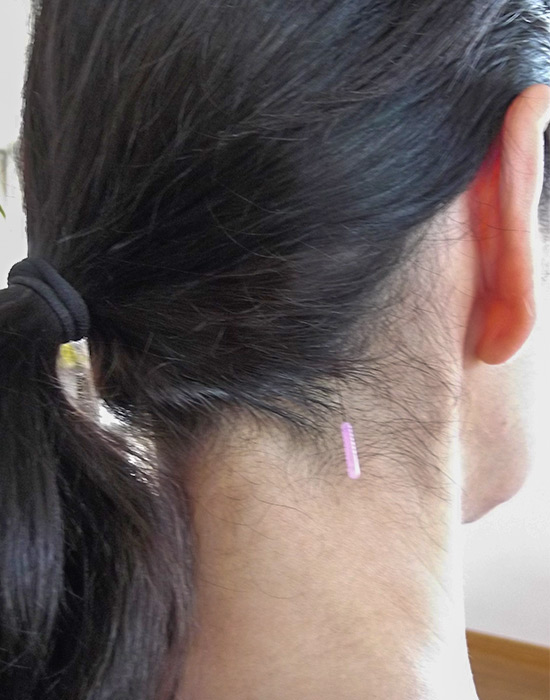 Akupunktur-Behandlung mit Akupunkturnadel